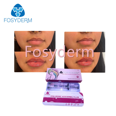 El llenador cutáneo ácido hialurónico de Fosyderm de la inyección para la cruz del labio 2ml ligó