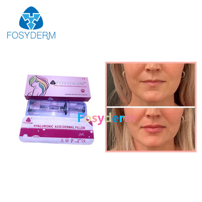 Línea ácida hialurónica de Derm de la inyección del aumento del labio de los llenadores cutáneos del labio de Fosyderm 2ml